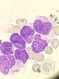 Hypogranular Promyelocytic Leukemia 2