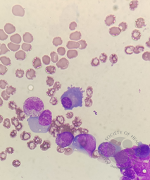 Plasma cell(Flame cell)