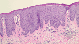 Cutaneous Psoriasis-Like Reaction to Talquetamab