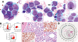 TP53-mutated AML with salmon-colored globules, a single Auer rod, pseudo–Chédiak-Higashi granules, and micronuclei