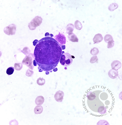 Giant Pronormoblast: A Hallmark of Parvovirus B19 Infection