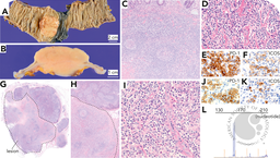 Primary colonic T-cell lymphoma with a TFH phenotype, favoring extranodal TFH lymphoma, angioimmunoblastic type