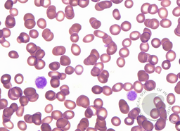 Giant platelets in Bernard-Soulier syndrome 1