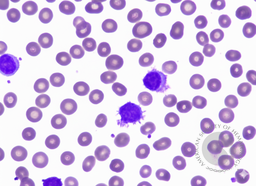 Splenic Marginal Zone Lymphoma with hairy projections