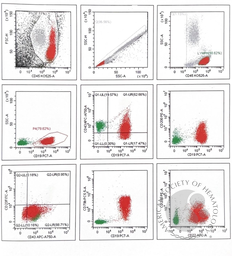 Flow cytometry in Splenic Marginal Zone Lymphoma 1