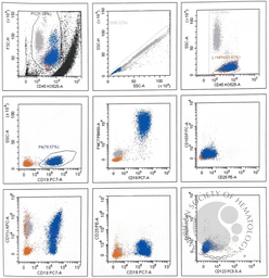 Flow cytometry in Splenic Marginal Zone Lymphoma 2