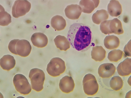 T-cell large granular lymphocytic leukemia 1
