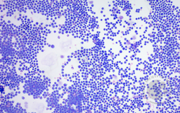 Myeloma in CSF low power