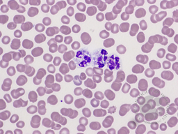 Capnocytophaga canimorsus sepsis