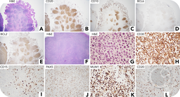 Follicular lymphoma transformed to classic Hodgkin lymphoma