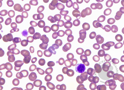 Giant platelets in Bernard-Soulier syndrome 2