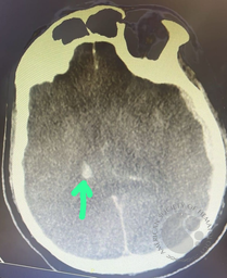 CT Scan brain showed intracranial hemorrhage(arrow)