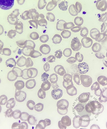 Basophilic stippling of red blood cells