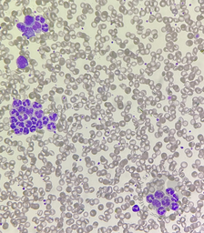 Neutrophil aggregation in sepsis