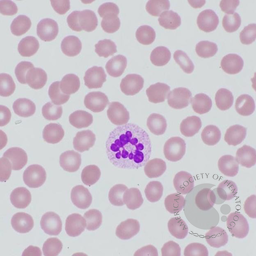 Markedly hypersegmented neutrophil in megaloblastic anemia