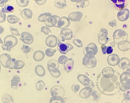Nucleated red blood cell (NRBC) with basophilic stippling