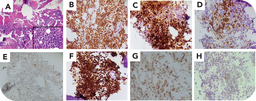 De novo CD19 B-ALL: awareness of a rare entity in initial diagnosis