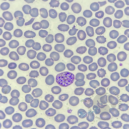 Plasmodium vivax schizont in peripheral blood smear (Field’s stain)