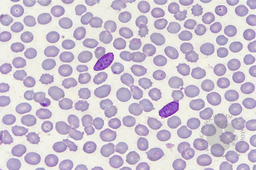 Plasmodium falciparum gametocytes in peripheral blood smear (Field stain, 100× oil immersion)