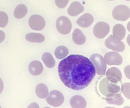Eosinophilic Myelocyte
