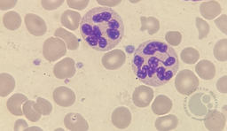 Hypersegmented Neutrophils in Peripheral Blood Smear