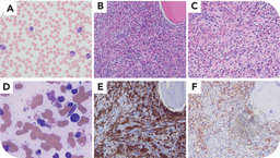 CD25 mast cell hyperplasia in myeloid/lymphoid neoplasm with PDGFRA rearrangement mimicking systemic mastocytosis
