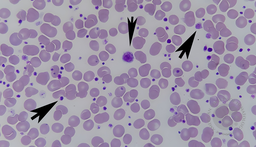 Giant Platelet in a Patient with Thrombocytosis