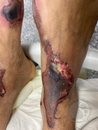 Dermal Thrombosis in a case of PNH