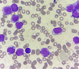 Acute myeloid leukemia with monocytic differentiation