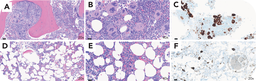 Focal MPN-associated JAK2-mutated skeletal lesion with normal blood counts and bone marrow