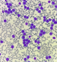 Acute monocytic leukemia