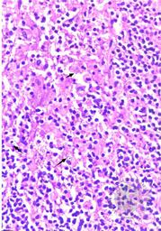 Primary bladder lymphoma with coexisting Malakoplakia