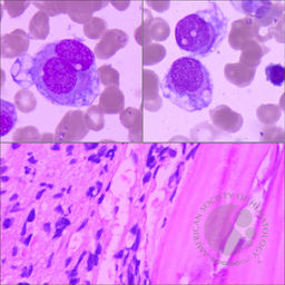 Rhabdomyosarcoma in bone marrow