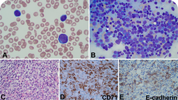 Pediatric acute erythroid leukemia with NUP98::KDM5A fusion