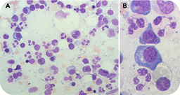 A WHIM of the marrow: myelokathexis as a cytological clue to a rare blood disorder