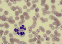 Pigment-laden neutrophil (malarial pigment)