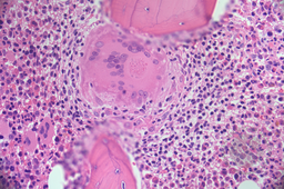 Giant multinucleate cell in bone marrow