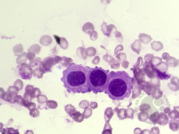 Reactive mesothelial cells in pericardial effusion 1