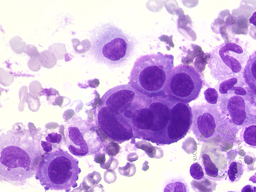 Reactive mesothelial cells in pericardial effusion 2