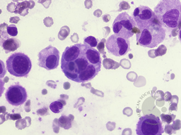 Reactive mesothelial cells in pericardial effusion 3