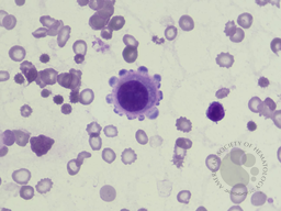 Reactive mesothelial cell in pericardial effusion 1