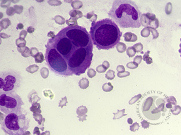 Reactive mesothelial cell in pericardial effusion 2