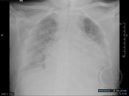 Chest X ray
