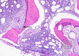 Bone trephine changes in hereditary hyperoxalosis 1