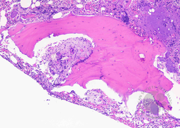 Bone trephine changes in hereditary hyperoxalosis 2