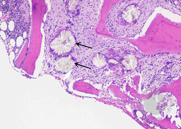 Hyperoxalosis (Crystals deposition) in bone trephine biopsy 1
