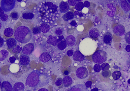 Hsitoplasmosis on bone marrow aspirate (Leishmann stain)
