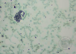 GMS Stain on histoplasmosis bone marrow aspirate