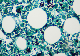 GMS Stain results on bone trephine section