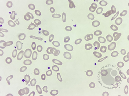 Elliptocytes/Pencil cells